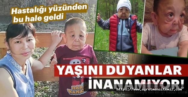 Hastalığı yüzünden bu hale geldi! Doğduktan 6 ay sonra bu hale geldi. Yaşını duyanlar inanamıyor