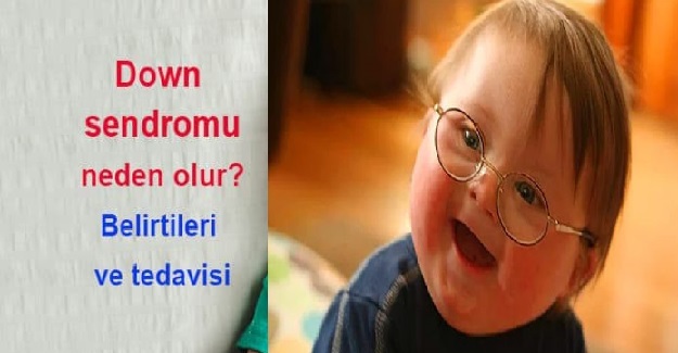 Down Sendromu nedir? Down Sendromu Nasıl Anlaşılır?