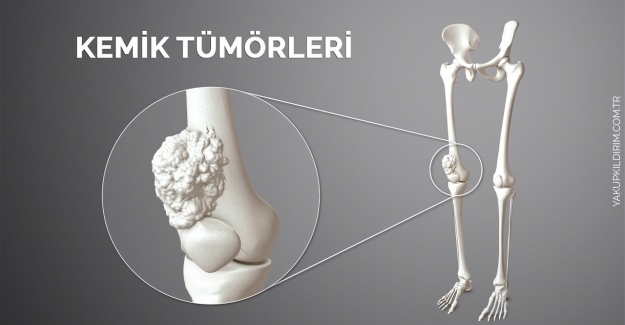 Kemik Tümörleri ve Tedavisi