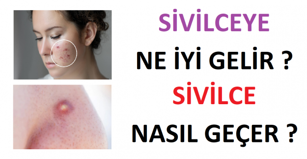 Sivilceye Ne İyi Gelir? Sivilce Nasıl Geçer ?