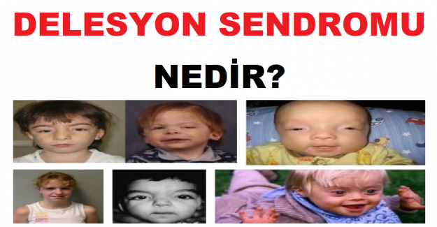 Delesyon Sendromu Nedir?