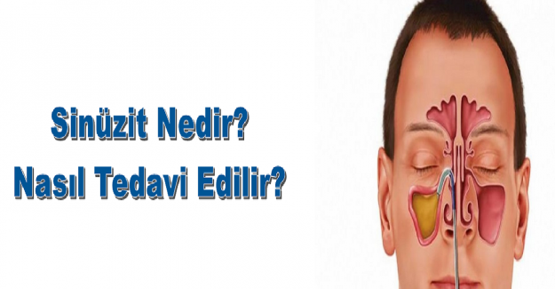 Sinüs Enfeksiyonu İçin Ne Yapılabilir?