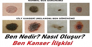 Ben Nedir? Benler Nasıl Oluşur? Ben Kanser İlişkisi