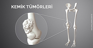Kemik Tümörleri ve Tedavisi